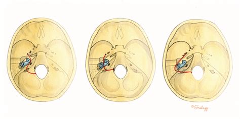 Temporal Bone Anatomy Ct Atlas