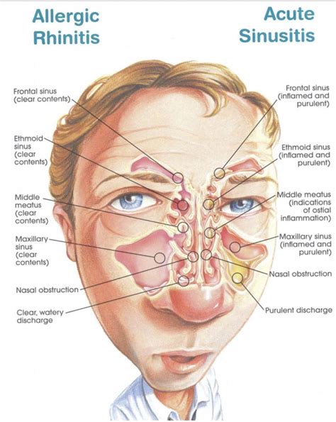 Sinusitis Sinus Anatomy HeadachesYouShouldWorryAbout Allergic