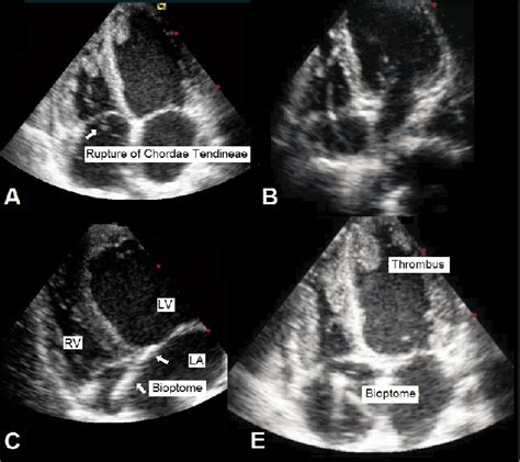 Chordae Tendineae Diagram