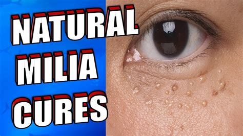 How To Get Rid Of White Fat Bumps Under Eyes Natural Milia Treatment