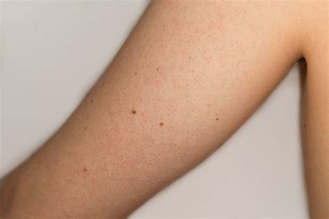 Reibeisenhautkeratosis Pilaris Behandlunghausmittel Reibeisenhaut