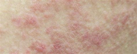 Symptoms And Pictures Skin Diseases Photo Gallery