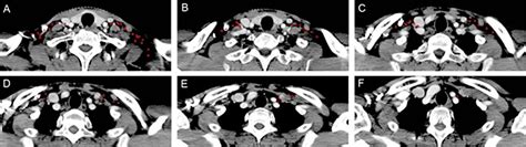 Optimization Of Cervical Lymph Node Clinical Target Volume Delineation