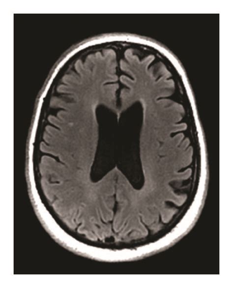 Patients Mri Revealing Left Thalamic Infarct And Chronic Small Vessel