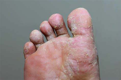 Types Of Fungal Foot Infections Jaws Podiatry