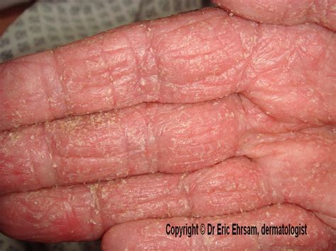 Dermoscopy Norwegian Scabies