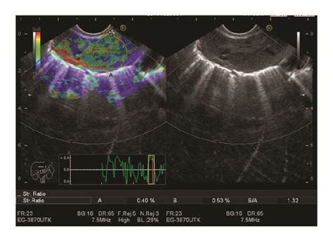 Benign Lymph Node With Elasticity Score Es 2 And Strain Ratio Sr 1