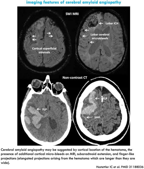 Intracerebral Hemorrhage Ich Emcrit Project