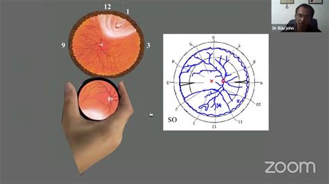 Pg Orientation Fundus Diagram Colour Coding Dr Biju John C Youtube