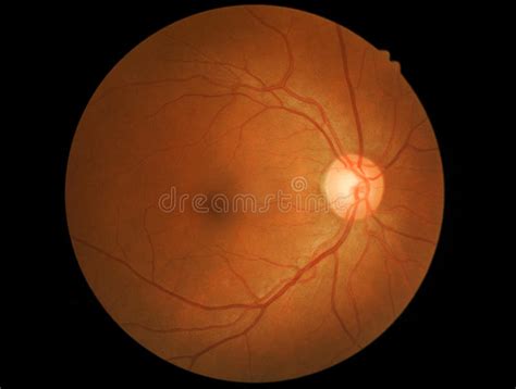 Photo Medical Detailing Retina And Optic Nerve Stock Photo Image Of