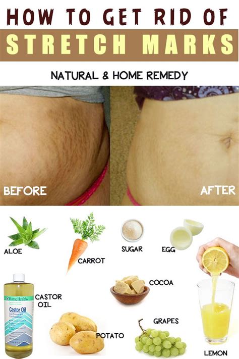 How To Get Rid Of Stretch Marks At Home Stretch