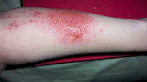 How To Get Rid Of Poison Ivy Rash Best Poison Ivy Remedies Ph