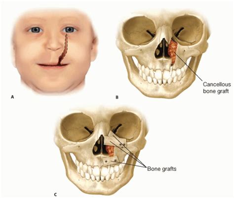 Surgical Management Of Facial Clefts Plastic Surgery Key