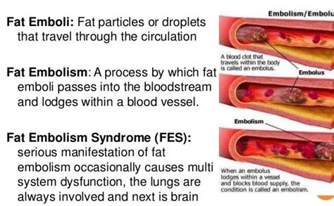 Fat Embolism Syndrome Bone And Spine