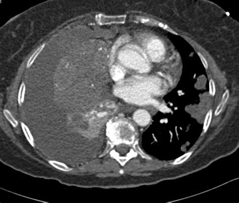 Small Cell Lung Cancer With Carcinomatosis Chest Case Studies