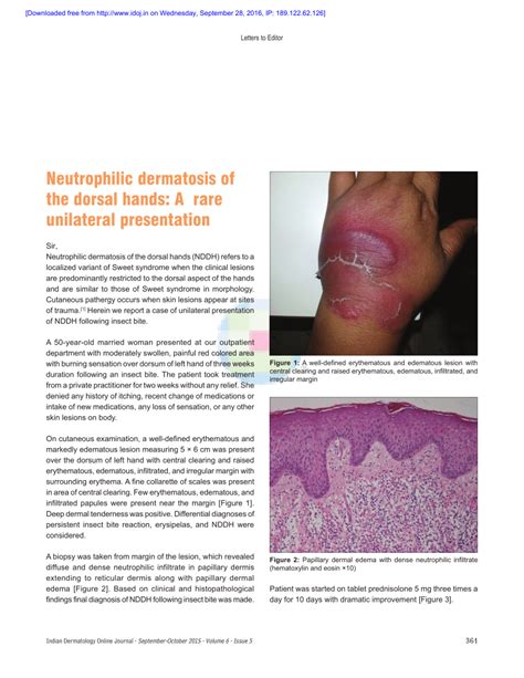 Pdf Neutrophilic Dermatosis Of The Dorsal Hands A Rare Unilateral
