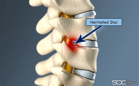 Common Herniated Disc Procedures Spine And Orthopedic Center