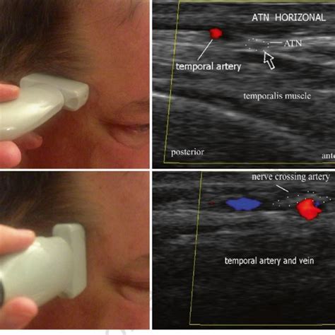 10 Ultrasound Evaluation Of The Auriculotemporal Nerve A Horizontal