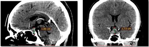 Sagittal And Coronal Contrast Enhanced Ct Images Showing Download