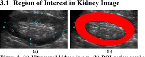 This can be due to acute tubular necrosis (nephrosis) or inflammation an acute exacerbation of renal disease may occur in some patients with chronic renal failure (acute on. Figure 2 from Stage Classification in Chronic Kidney Disease by Ultrasound Image | Semantic Scholar
