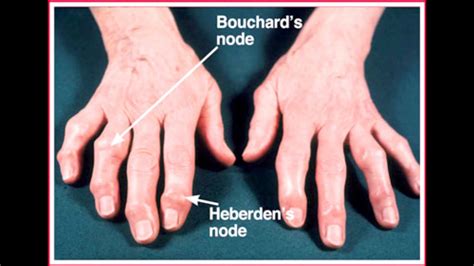Heberden39s Nodes Causes Symptoms And Treatment