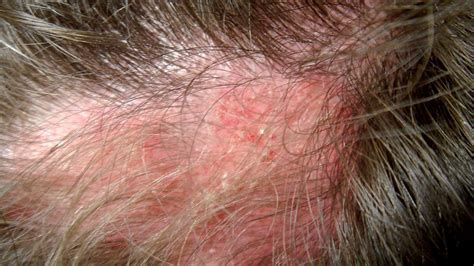 Alopecia And Systemic Lupus Erythematosus Correlations Not To Be