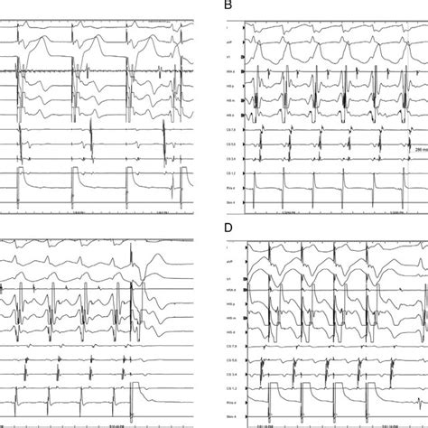 A Right Ventricular Rv Pacing At 600 Milliseconds At The Start Of