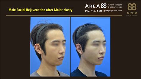 korean medical technique male facial rejuvenation youtube