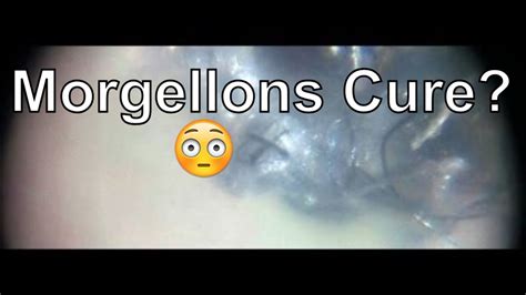 How To Cure Morgellons Youtube