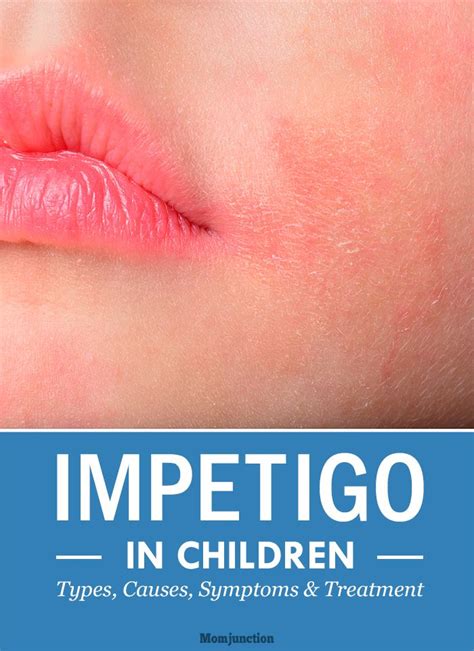 What Is The Best Way To Prevent Impetigo Infection Makhikruwrogers