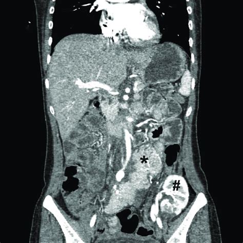 Radiologic Followup After Combined Kidney Pancreas Transplantation