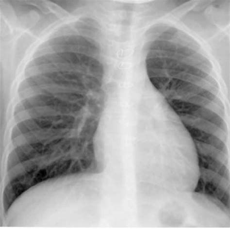 Preoperative Frontal Chest Radiograph Shows Severe Cardiomegaly