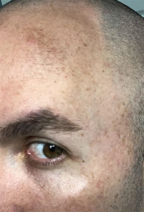 Sun Spots On Forehead Does Anything Actually Work Skin Concerns R