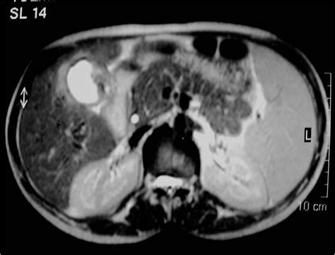 Tuberculosis Of The Gall Bladder A Case Report Eurorad