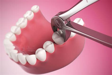 How Do Your Gums Heal After A Tooth Extraction