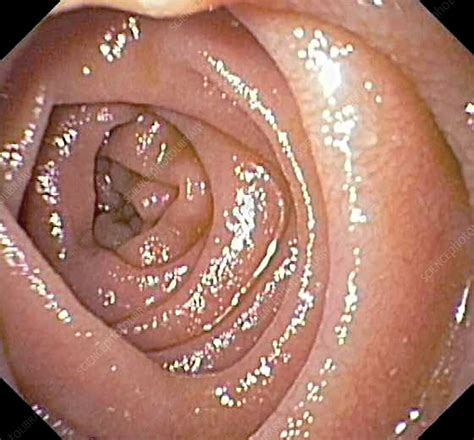 The small intestine or small bowel is an organ in the gastrointestinal tract where most of the absorption of nutrients and minerals from food takes place. Small intestine, endoscope view - Stock Image - C041/5855 ...