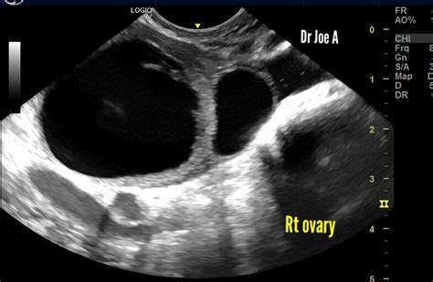 Ultrasound Imaging Early Gestation With Ovarian Cyst