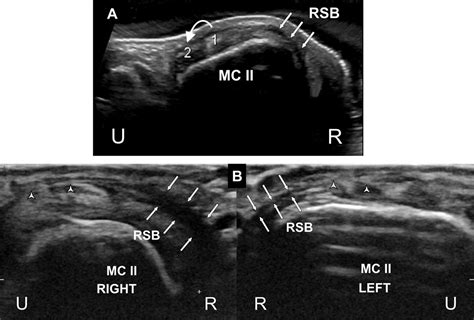 Ultrasound Follow Up Of Posttraumatic Injuries Of The Sagittal Band Of