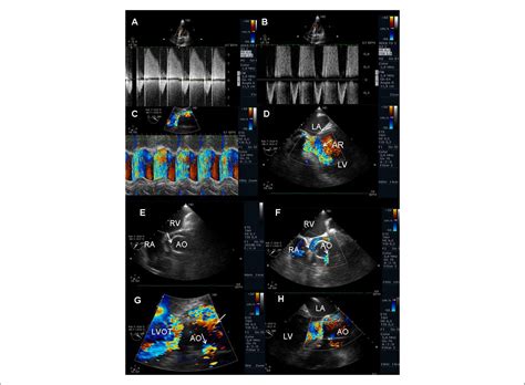 Scielo Brasil Acute Myocardial Infarction And Severe Prosthetic