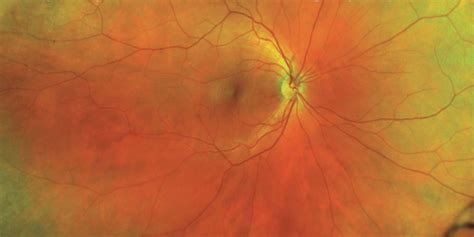 Ultra Widefield Retinal Imaging Noosa Optical Noosa Junction