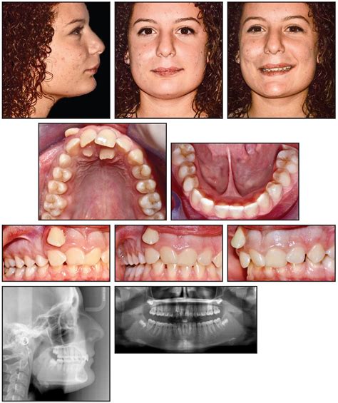 Aligner Treatment of Transposed Maxillary Canines and Lateral Incisors
