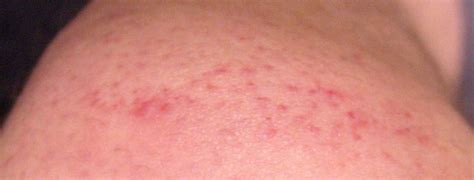 Rashes On Shoulders Pictures Photos