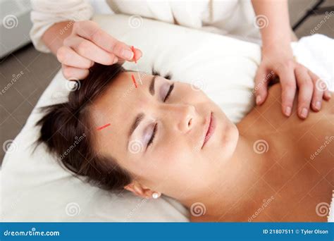 De Gezichts Stimulatie Van De Naald Van De Behandeling Van De Acupunctuur Stock Afbeelding