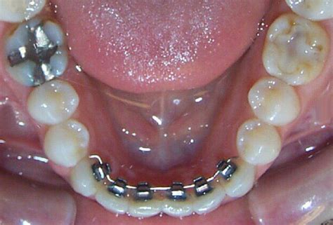 Lingual Braces Inside Braces Ortho Orthodontics Toronto