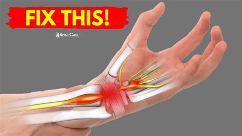 How To Fix Wrist Pain For Good Spinecare St Joseph Michigan