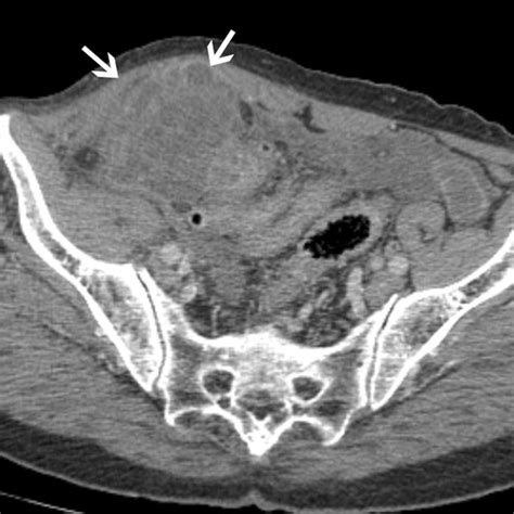 Abdominal Ct In The Transverse Plane Shows A Multiloculated Cystic Mass