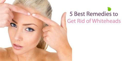 5 Best Remedies To Get Rid Of Whiteheads Business Insides