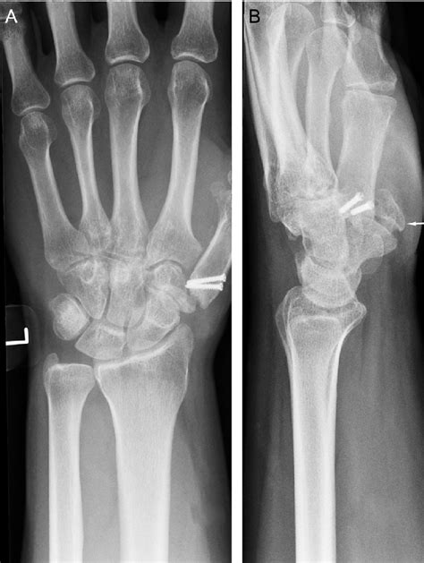 Radiographs At The 1 Year Follow Up Anterior Posterior View A And