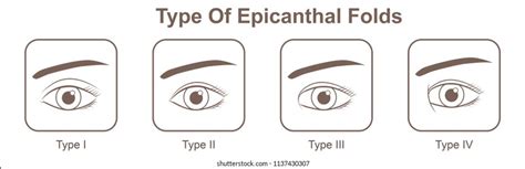 Epicanthal Folds Vs Normal
