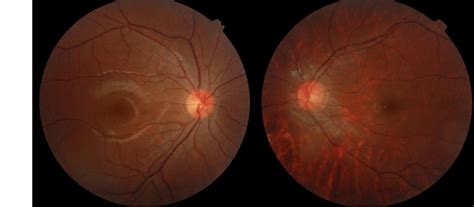 Fundus Photographs Showing The Normal Appearance In The Right Eye And